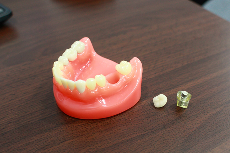 違和感がない!まるで自分の歯のようなインプラントを提供します